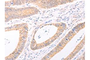 The image on the left is immunohistochemistry of paraffin-embedded Human colon cancer tissue using ABIN7131482(TRIM32 Antibody) at dilution 1/40, on the right is treated with fusion protein. (TRIM32 抗体)