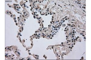 Immunohistochemical staining of paraffin-embedded Adenocarcinoma of breast tissue using anti-DHFR mouse monoclonal antibody. (Dihydrofolate Reductase 抗体)