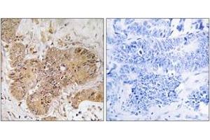 Immunohistochemistry analysis of paraffin-embedded human colon carcinoma tissue, using LUC7L2 Antibody. (LUC7L2 抗体  (AA 129-178))
