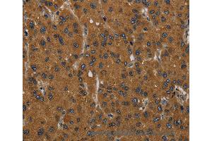 Immunohistochemistry of Human liver cancer using MIER2 Polyclonal Antibody at dilution of 1:60 (MIER2 抗体)