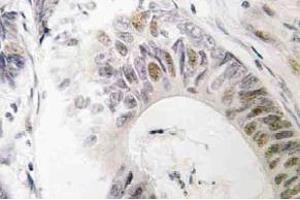 Immunohistochemistry (IHC) analyzes of Rad51 antibody in paraffin-embedded human colon carcinoma tissue. (RAD51 抗体)