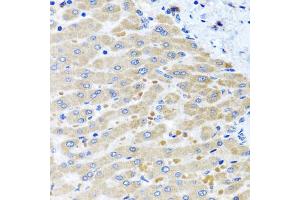 Immunohistochemistry of paraffin-embedded human liver injury using DARS2 antibody (ABIN5975194) at dilution of 1/100 (40x lens). (DARS2 抗体)
