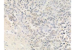 ABIN6259340 and ABIN6275456 at 1/100 staining human Hodgkin lymphoma by IHC-P. (RRAGA/B 抗体)