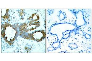 Immunohistochemical analysis of paraffin-embedded human breast carcinoma tissue using PAK1/PAK2/PAK3(Phospho-Thr423/Thr402/Thr421) Antibody(left) or the same antibody preincubated with blocking peptide(right). (PAK1/2/3 抗体  (pThr423))