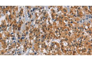 Immunohistochemistry of paraffin-embedded Human thyroid cancer using SMAD9 Polyclonal Antibody at dilution of 1:30 (SMAD9 抗体)