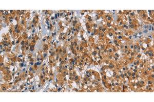 Immunohistochemistry of paraffin-embedded Human thyroid cancer using SMAD9 Polyclonal Antibody at dilution of 1:30