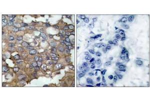 Immunohistochemical analysis of paraffin-embedded human breast carcinoma tissue using Src (Ab-529) antibody (E021168). (Src 抗体)