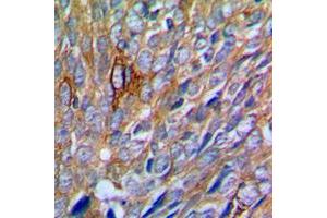 Immunohistochemical analysis of PAK1 staining in human prostate cancer formalin fixed paraffin embedded tissue section. (PAK1 抗体  (Center))