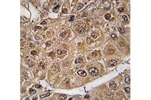 IHC analysis of FFPE human hepatocarcinoma tissue stained with SUMO2/3 Antibody antibody (SUMO2/3 抗体  (AA 53-84))