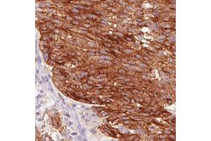 Immunohistochemical staining (Formalin-fixed paraffin-embedded sections) of human melanoma with STX7 monoclonal antibody, clone CL0257  shows strong cytoplasmic and membrane positivity in tumor cells. (Syntaxin 7 抗体)