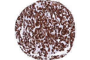 Adrenocortical carcinoma showing strong STAR immunostaining of tumor cells (Recombinant STAR 抗体)