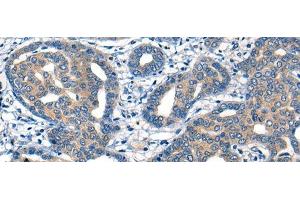 Immunohistochemistry of paraffin-embedded Human liver cancer tissue using MIIP Polyclonal Antibody at dilution of 1:45(x200) (MIIP 抗体)