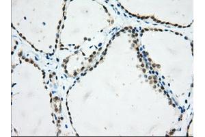 Immunohistochemical staining of paraffin-embedded Adenocarcinoma of Human colon tissue using anti-USP5 mouse monoclonal antibody. (USP5 抗体)
