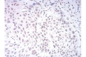 Immunohistochemical analysis of paraffin-embedded esophageal cancer tissues using AOF1 mouse mAb with DAB staining.