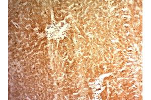Formalin-fixed, paraffin-embedded human Hepatocellular Carcinoma (HCC) stained with Glypican-3 Monoclonal Antibody (1G12) (Glypican 3 抗体  (AA 511-580))
