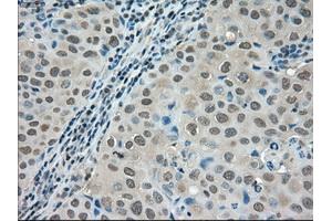Immunohistochemical staining of paraffin-embedded Adenocarcinoma of colon tissue using anti-LDHAmouse monoclonal antibody. (Lactate Dehydrogenase A 抗体)