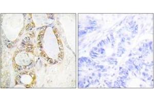 Immunohistochemistry analysis of paraffin-embedded human colon carcinoma tissue, using MUC13 Antibody. (MUC13 抗体  (AA 421-470))