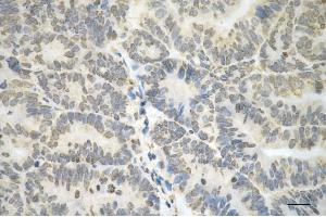 Immunohistochemistry was performed on paraffin-embedded human endometrial carcinoma using vimentin antibody (ABIN7800836), 1:100). (Vimentin 抗体)