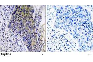 Immunohistochemistry analysis of paraffin-embedded human lung carcinoma tissue using MRPL34 polyclonal antibody . (MRPL34 抗体)