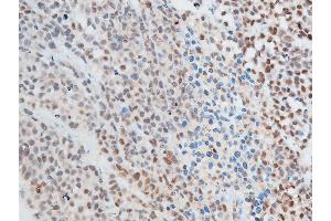 ABIN6267250 at 1/100 staining rat cancer tissue sections by IHC-P. (CHEK2 抗体  (pThr387))