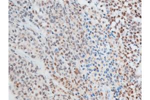 ABIN6267250 at 1/100 staining rat cancer tissue sections by IHC-P. (CHEK2 抗体  (pThr387))
