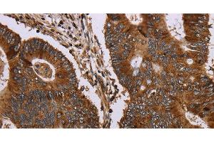 Immunohistochemistry of paraffin-embedded Human colon cancer tissue using MAGEC2 Polyclonal Antibody at dilution 1:40 (MAGEC2 抗体)