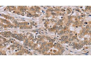 Immunohistochemistry of paraffin-embedded Human liver cancer tissue using CLEC16A Polyclonal Antibody at dilution 1:45 (CLEC16A 抗体)