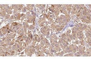 ABIN6276489 at 1/100 staining Human Melanoma tissue by IHC-P. (GPX5 抗体  (Internal Region))