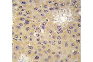 IHC analysis of FFPE human hepatocarcinoma tissue stained with ACAT1 antibody (ACAT1 抗体  (AA 296-329))