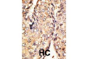 Formalin-fixed and paraffin-embedded human cancer tissue reacted with GDF10 polyclonal antibody  , which was peroxidase-conjugated to the secondary antibody, followed by DAB staining. (GDF10 抗体  (N-Term))