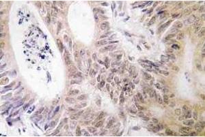 Immunohistochemistry (IHC) analyzes of MSK1 antibody in paraffin-embedded human colon carcinoma tissue. (MSK1 抗体)