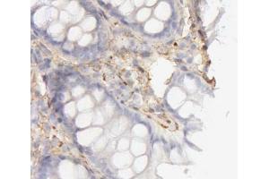 ABIN6266830 at 1/100 staining human colon cancer tissues sections by IHC-P. (COL4A1 抗体)