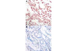 Immunohistochemical staining of human breast cancer tissue by NFKB2 (phospho S866) polyclonal antibody  without blocking peptide (A) or preincubated with blocking peptide (B) under 1:50-1:100 dilution. (NFKB2 抗体  (pSer866))