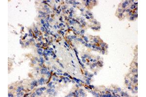 Anti-CYP27B1 Picoband antibody, IHC(P) IHC(P): Human Kidney Cancer Tissue (CYP27B1 抗体  (C-Term))