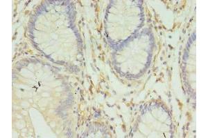 Immunohistochemistry of paraffin-embedded human colon cancer using ABIN7155609 at dilution of 1:100 (HLA-DRB4 抗体  (AA 30-227))