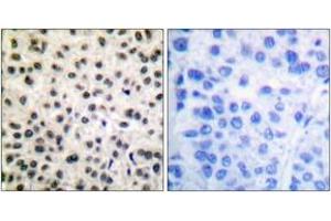 Immunohistochemistry analysis of paraffin-embedded human breast carcinoma, using MEF2A (Phospho-Ser408) Antibody. (MEF2A 抗体  (pSer408))