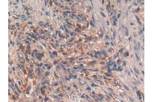 DAB staining on IHC-P; Samples: Human Lung cancer Tissue (GHRH 抗体  (AA 19-108))
