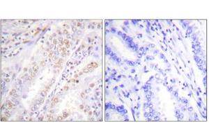 Immunohistochemistry analysis of paraffin-embedded human lung carcinoma tissue, using XRCC2 antibody. (XRCC2 抗体  (C-Term))