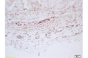 Formalin-fixed and paraffin embedded human skin labeled with Anti-Factor VIII Polyclonal Antibody, Unconjugated (ABIN872493) at 1:200 followed by conjugation to the secondary antibody and DAB staining