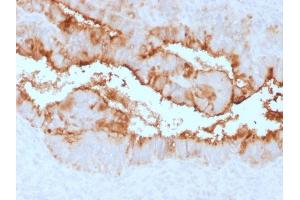 Formalin-fixed, paraffin-embedded human Endometrial Carcinoma stained with MUC16 Rabbit Recombinant Monoclonal Antibody (OCA125/2349R). (Recombinant MUC16 抗体)