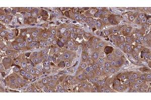 ABIN6273842 at 1/100 staining Human liver cancer tissue by IHC-P. (CMKLR1 抗体  (Internal Region))