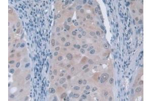 DAB staining on IHC-P; Samples: Human Breast cancer Tissue (GFM1 抗体  (AA 1-158))