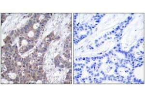 Immunohistochemical analysis of paraffin-embedded human breast carcinoma tissue using Stathmin 1(Phospho-Ser16) Antibody(left) or the same antibody preincubated with blocking peptide(right). (Stathmin 1 抗体  (pSer16))
