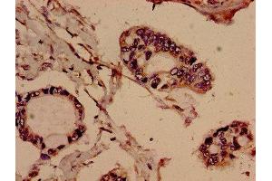 Immunohistochemistry analysis of human pancreatic cancer using ABIN7151520 at dilution of 1:100 (EVC 抗体  (AA 493-602))