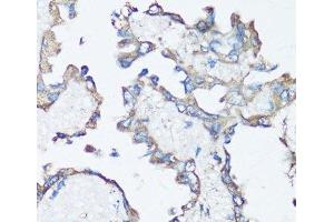 Immunohistochemistry of paraffin-embedded Human lung cancer using SRC Polyclonal Antibody at dilution of 1:100 (40x lens). (Src 抗体)