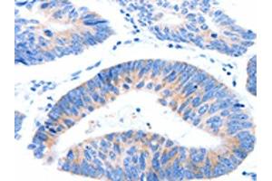 The image on the left is immunohistochemistry of paraffin-embedded Human colon cancer tissue using ABIN7191546(MUC3A Antibody) at dilution 1/60, on the right is treated with synthetic peptide. (MUC3A 抗体)