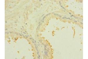 Immunohistochemistry of paraffin-embedded human prostate cancer using ABIN7168444 at dilution of 1:100 (ROBO2 抗体  (AA 450-660))