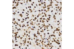 Immunohistochemistry of paraffin-embedded human liver cancer using DiMethyl-Histone H3-K27 antibody. (Histone 3 抗体  (H3K27me))