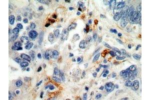 IHC analysis of paraffin-embedded human stomach cancer cells using S100A8 Antibody (dilution 1:100). (S100A8 抗体)
