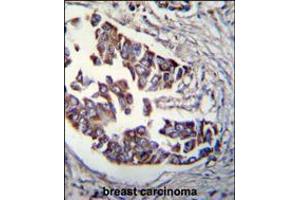 Rad9 Antibody (S387) immunohistochemistry analysis in formalin fixed and paraffin embedded human breast carcinoma followed by peroxidase conjugation of the secondary antibody and DAB staining.
